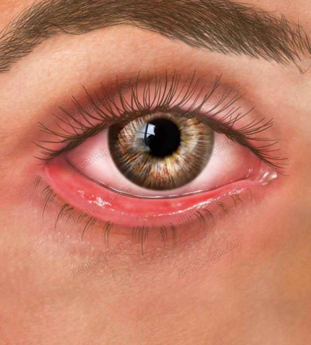 Схематичный рисунок выворота нижнего века. Это состояние может возникать в пожилом возрасте, когда ослабевает тонус круговой мышцы глаза и при ошибках нижней блефаропластики.