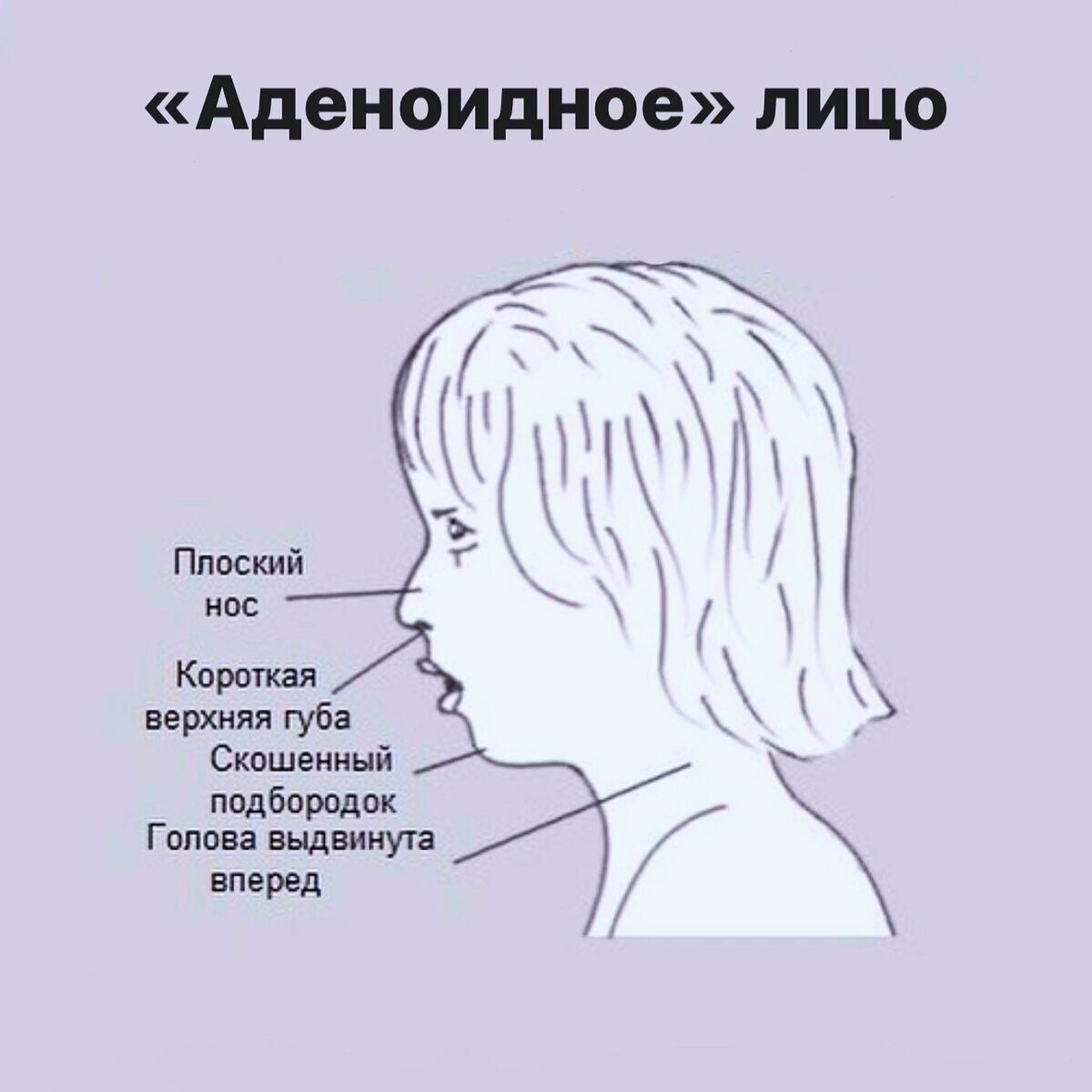 Нефизиологичное дыхание накладывает отпечаток на внешность