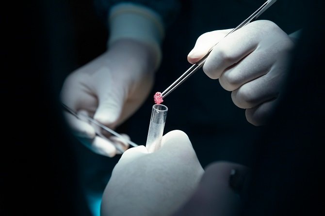 

La Roche-Posay Fondation and Childhood Cancer International




Биопсия при онкологии: что за анализ, виды, как проводится

Биопсия при онкологии: что за анализ, виды, как проводится
