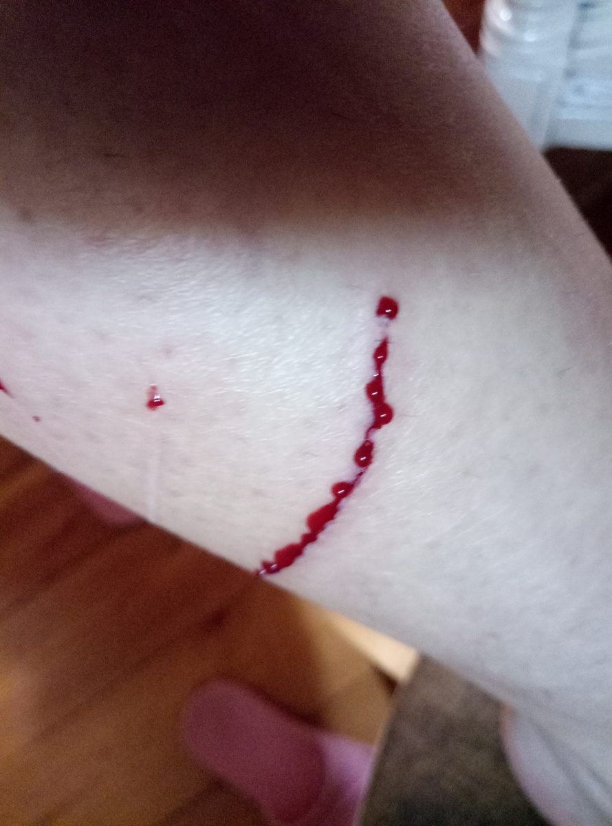 Остался шрам.