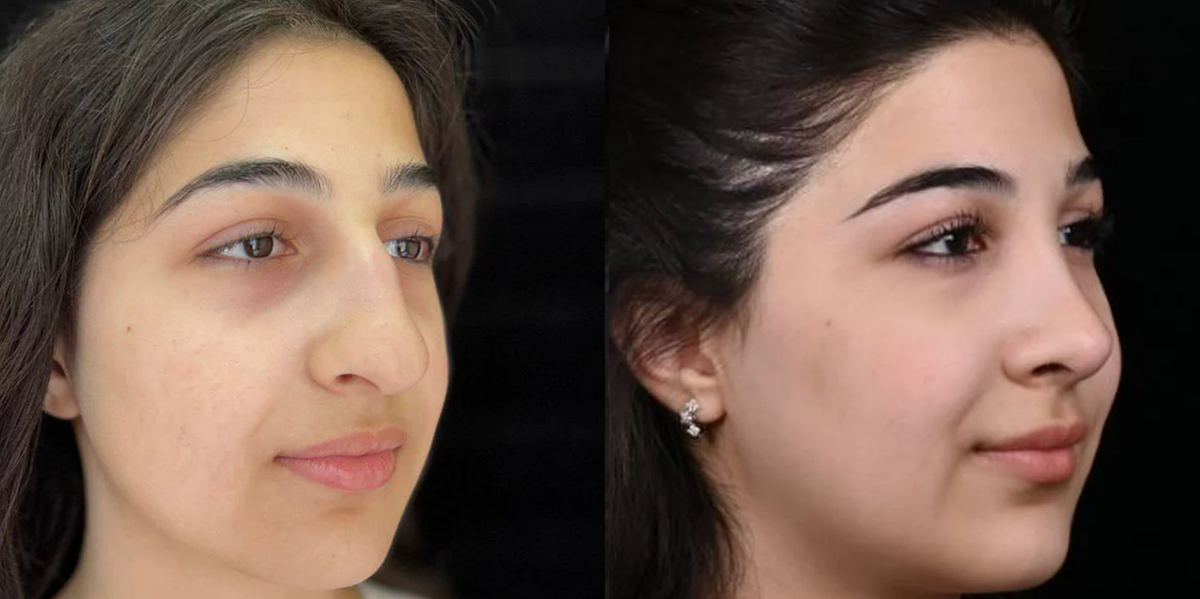 Убрали горбинку, чуть укоротили спинку и уменьшили кончик носа. Фото до и после. Фото с сайта хирурга Д.Р. Гришкяна. Имеются противопоказания, требуется консультация специалиста