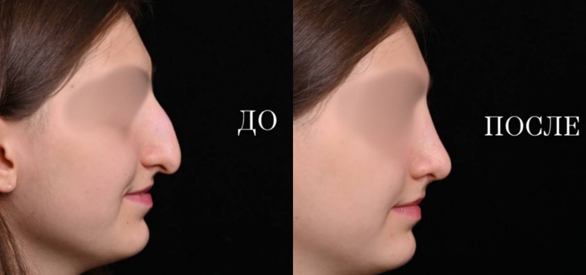 Ринопластика фото до и после. Фото с сайта хирурга Д.Р. Гришкяна. Имеются противопоказания, требуется консультация специалиста