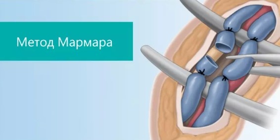 Операция Мармара при варикоцеле