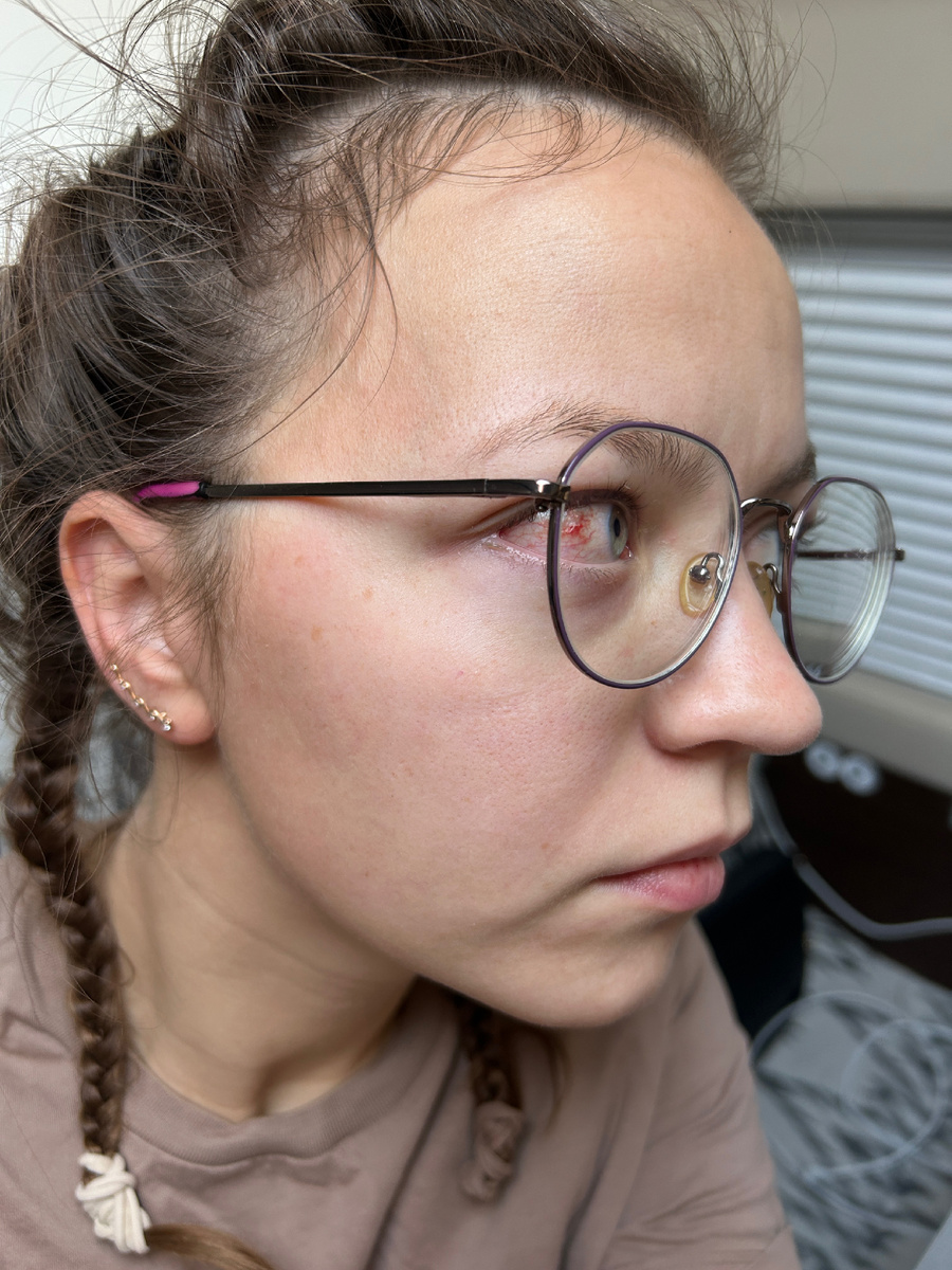 Покроснение в глазу в первое утро выглядело так