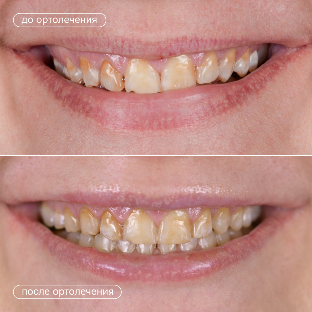 До и после ортодонтического лечения