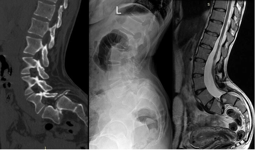 А вот и снимки пациентки. 100% листез! Как не оперировать!  