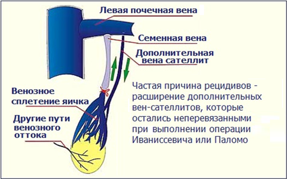 Дополнительная вена-сателлит, оставшаяся непервязанной