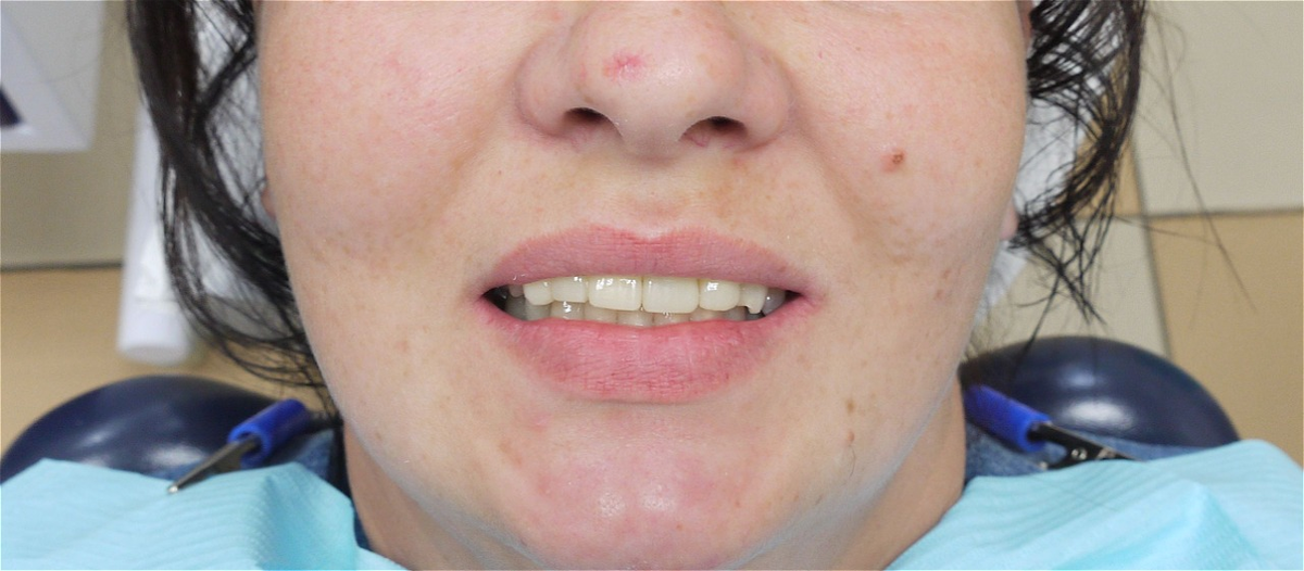 Результат протезирования в стоматологии Денталюкс