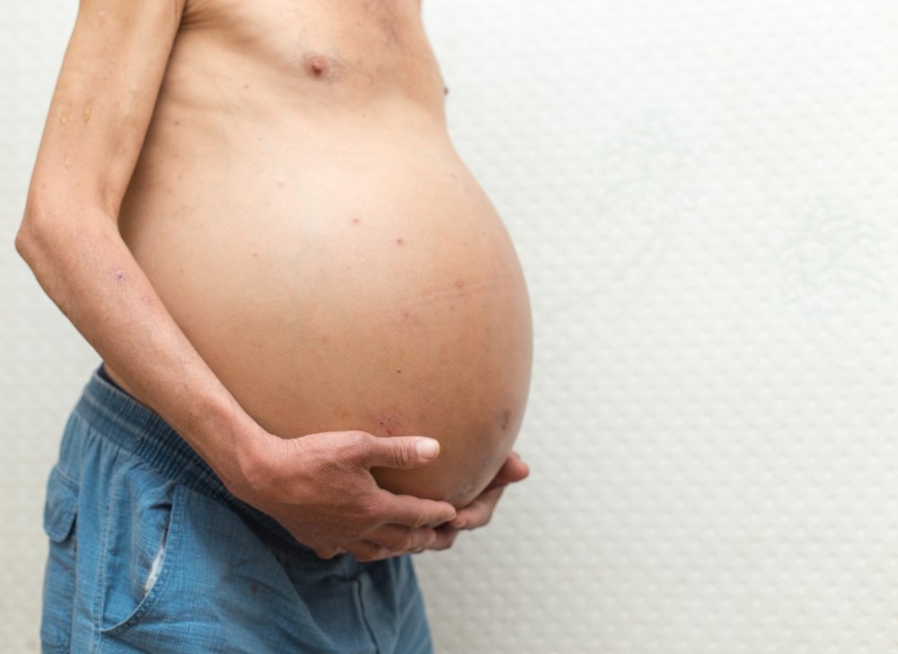 Асцит при онкологии