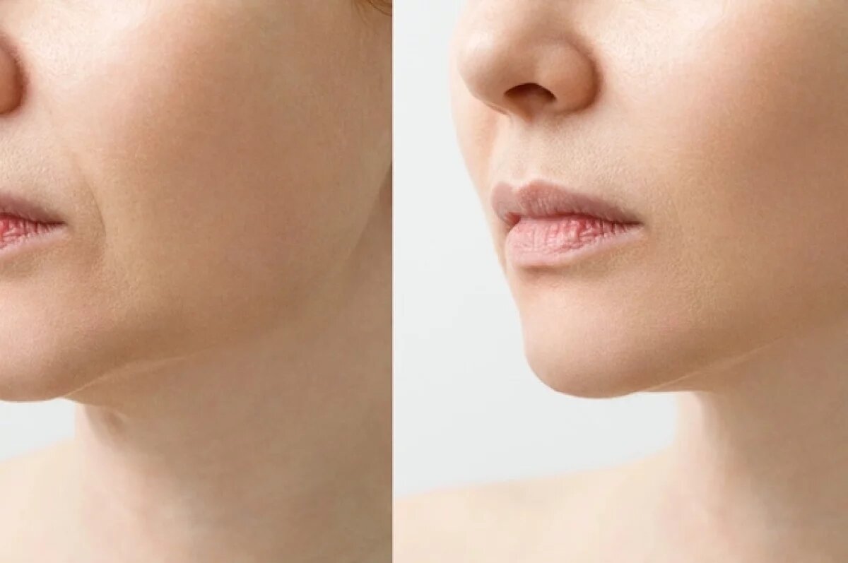    Без операций.