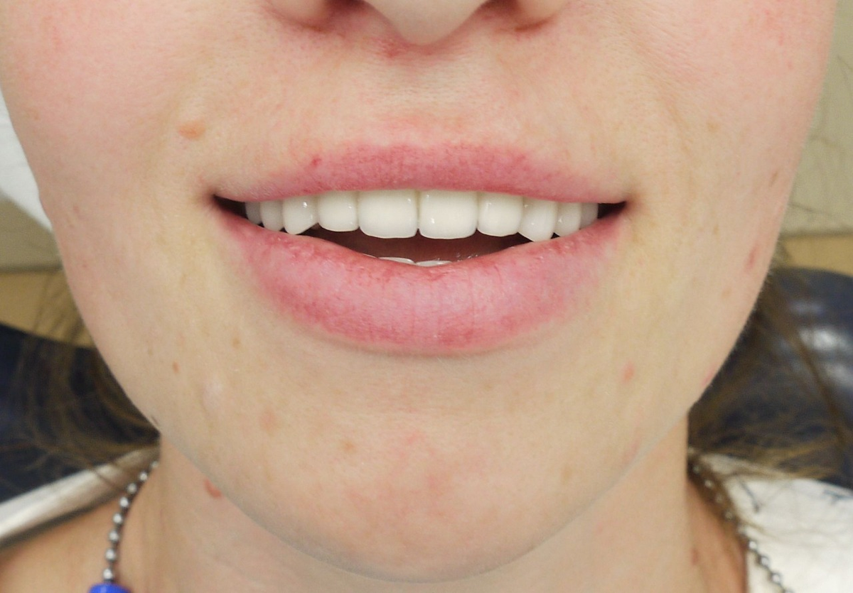 Результат протезирования в стоматологии Денталюкс