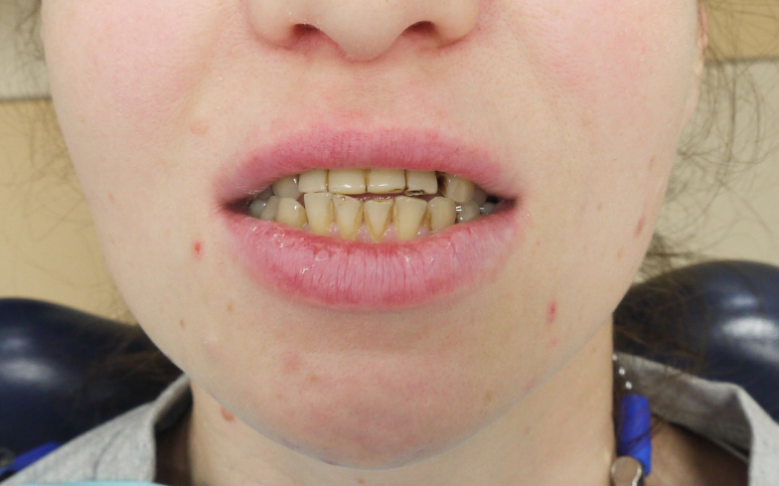 Первое обращение в стоматологию Денталюкс Рязань