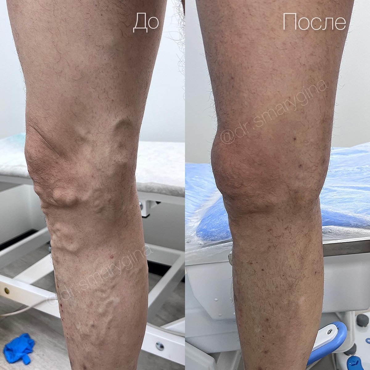 Пациенту было выполнено лечение методом ЭВЛК без боли, разрезов, шрамов и реабилитации