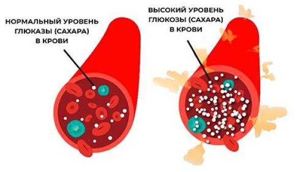 Стрессовая гипергликемия: причины, симптомы и лечение 