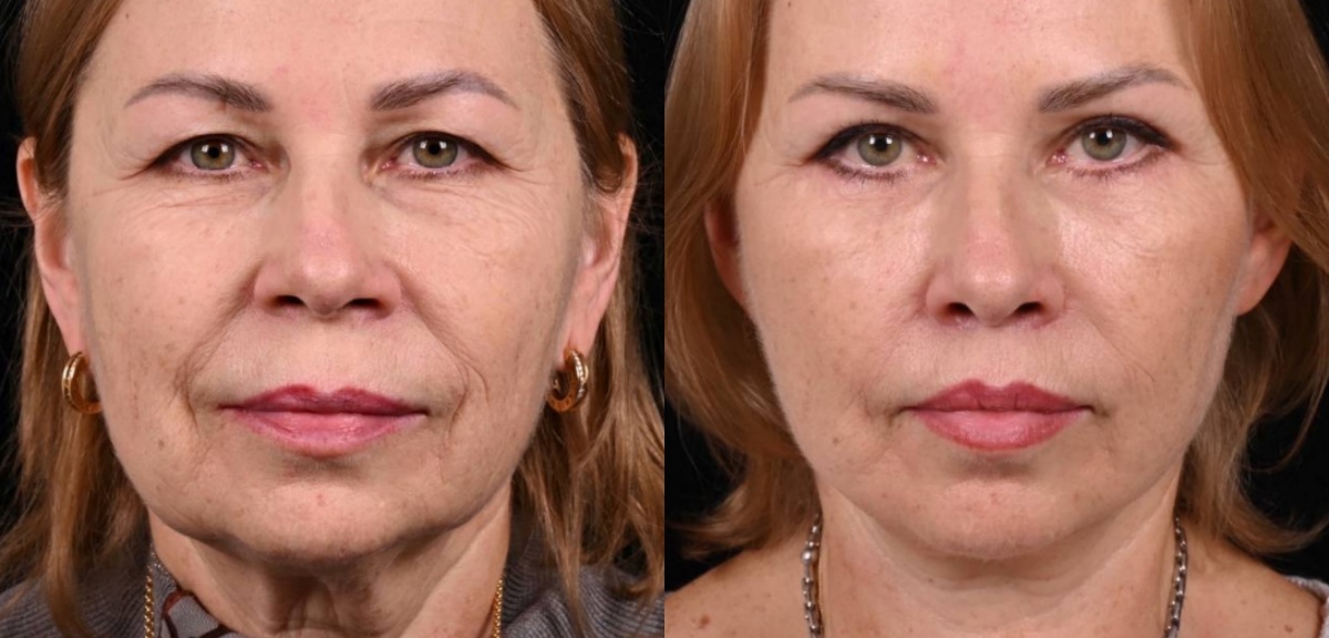 Пластика лица MACS-lift, булхорн, пластика центральной части шеи, круговая блефаропластика. Фото до и после. Фото с сайта хирурга Д.Р. Гришкяна. Имеются противопоказания, требуется консультация специалиста