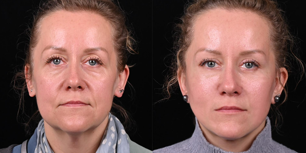 Пластика лица Macs-lift фото до и после. Фото с сайта хирурга Д.Р. Гришкяна. Имеются противопоказания, требуется консультация специалиста