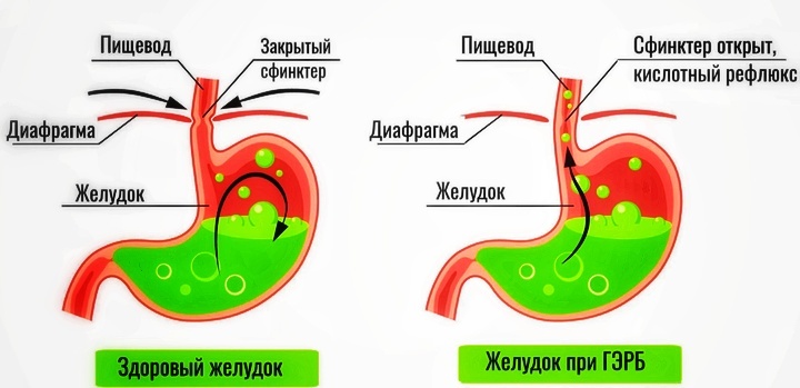 Сравнение здорового желудочно-пищеводного перехода и при ГЭРБ