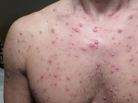 Высыпание при кори.