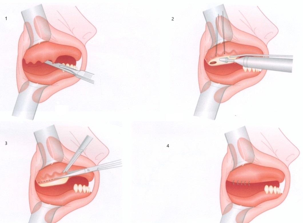 Редукция: 1. Разрез, 2. Спиливание костного гребня, 3. Коррекция десневого лоскута, 4. Ушивание