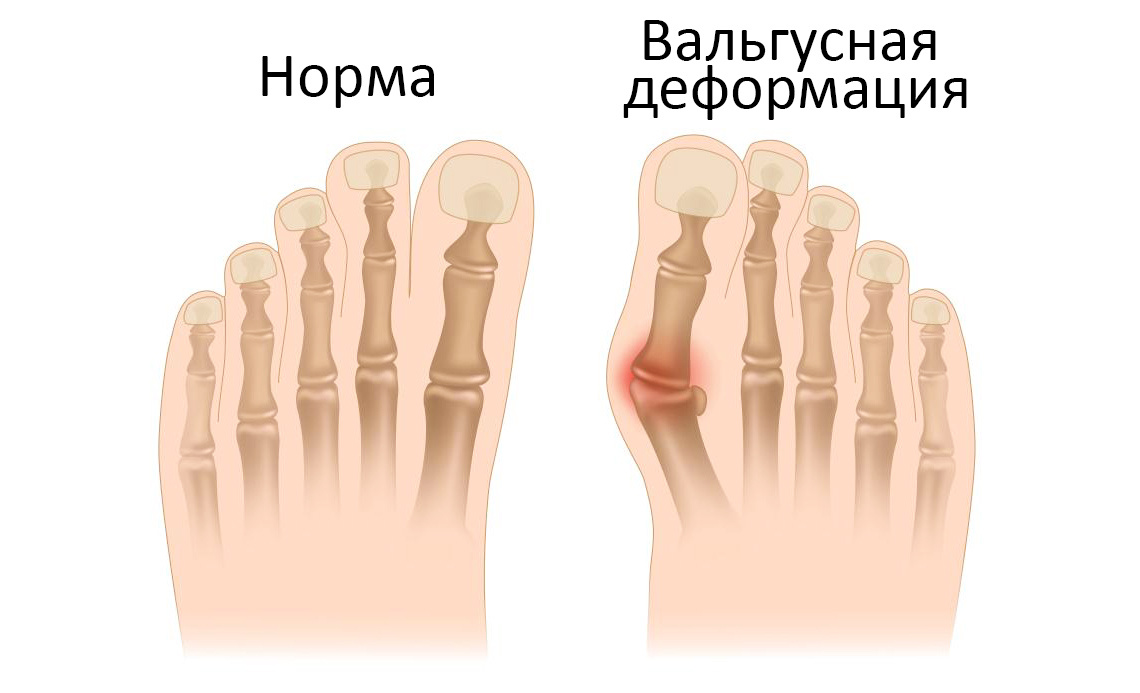 На фото пример вальгусной деформации стопы. Источник: gkb81.ru