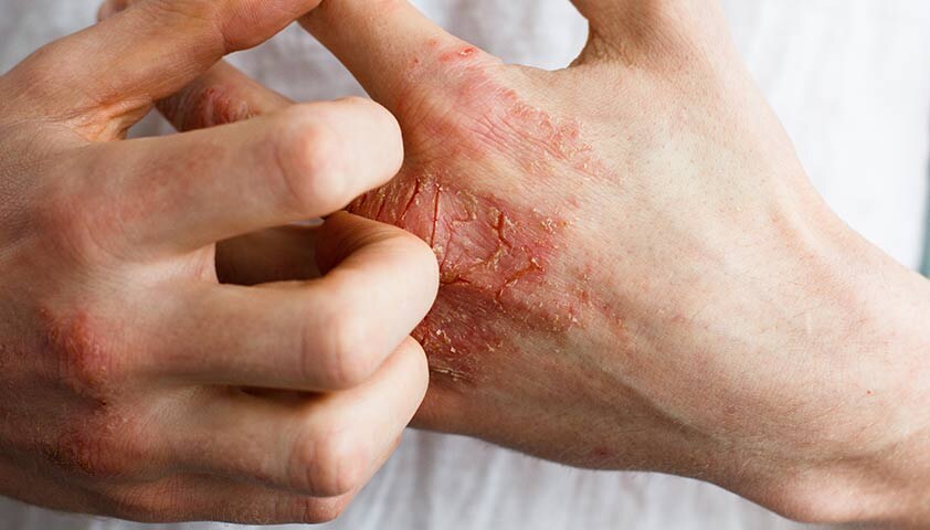 Дерматит — один из ярких признаков дефицита витамина B6