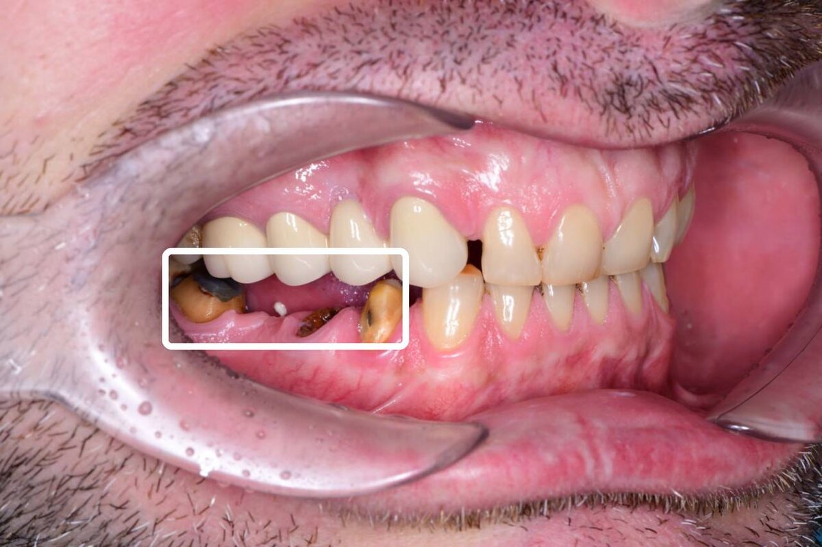 У пациента слетел мостовидный протез