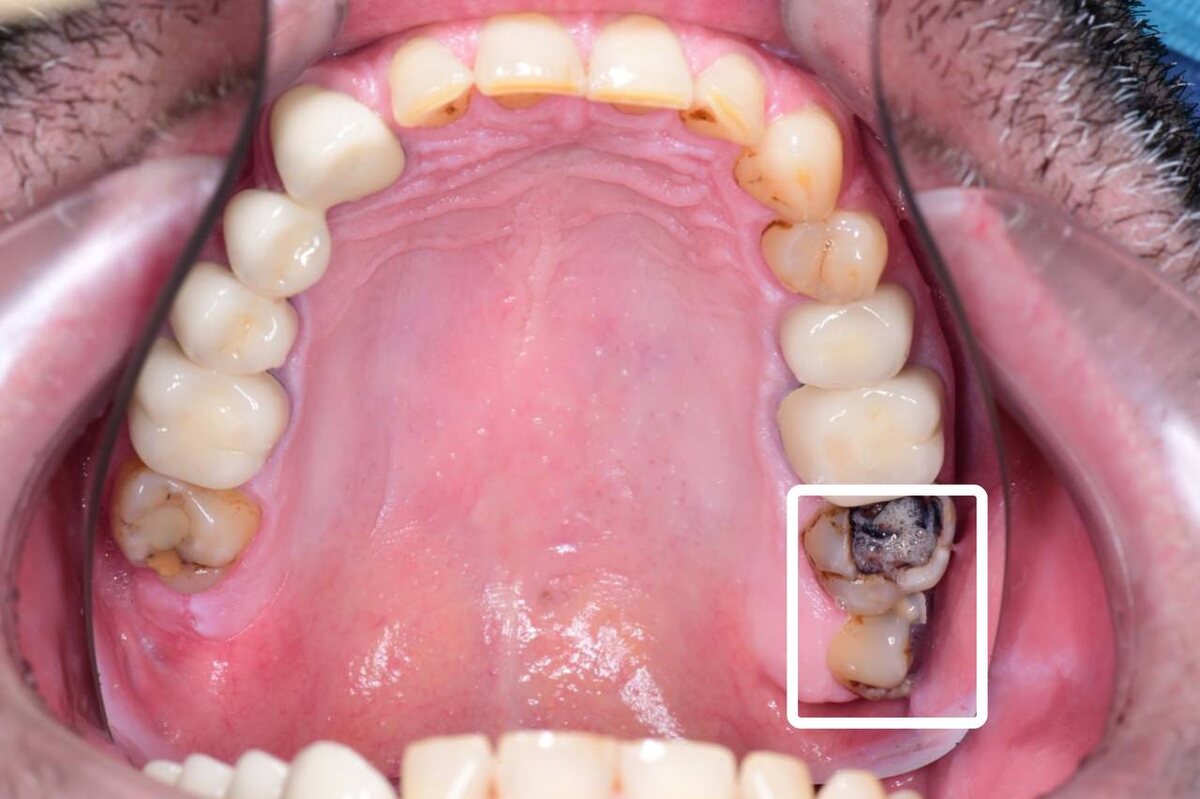 Разрушены зубы 2.7 и 2.8.