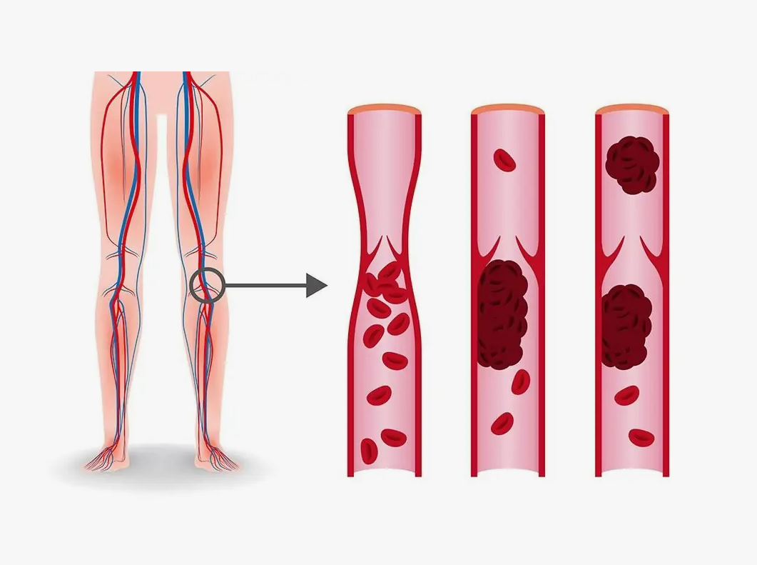 Изображения сгустков крови