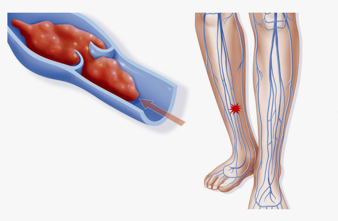 Тромбоз предплюсневого сустава