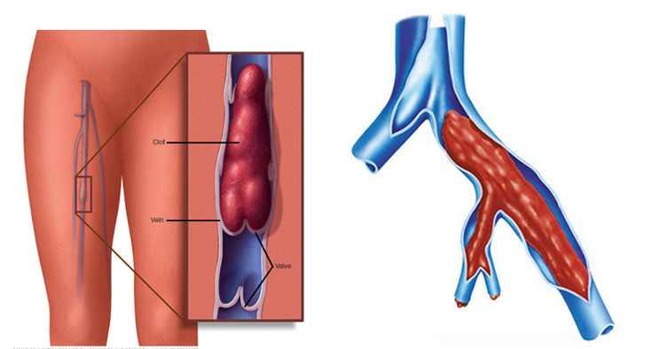 Тромбоз склонен к ряду побочных реакций