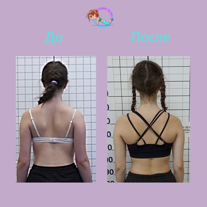 Пациентка Г. в 2023 году, в возрасте 13 лет обратилась в наш центр к врачу ортопеду кмн Шавырину И. А с диагнозом юношеский идиопатический сколиоз второй степени. Градусы искривление на тот момент 20-18. Было назначено  выполнение индивидуально подобранной гимнастики Шрот. 

🔍Пациентка прошла первичный курс гимнастики Шрот у врача ЛФК Шрот-терапевта Журавлевой Ю.С. и в дальнейшем продолжила самостоятельное  выполнение в домашних условиях. Так же пациентка приняла участие в 3 наших Шрот интесивах под руководством Журавлевой Ю. С.‼️ Летний, осенний 2023, лето 2024 и вновь поедет будущей зимой❄️.  Результаты говорят сами за себя🫠: 

✅ Угол деформации уменьшился с 20 до 13 градусов в грудном отделе и с 18 до 7 в поясничном отделе.
И это все только на гимнастике Шрот!
🔥Прекрасный рентгенологический и косметический результат❗❤️