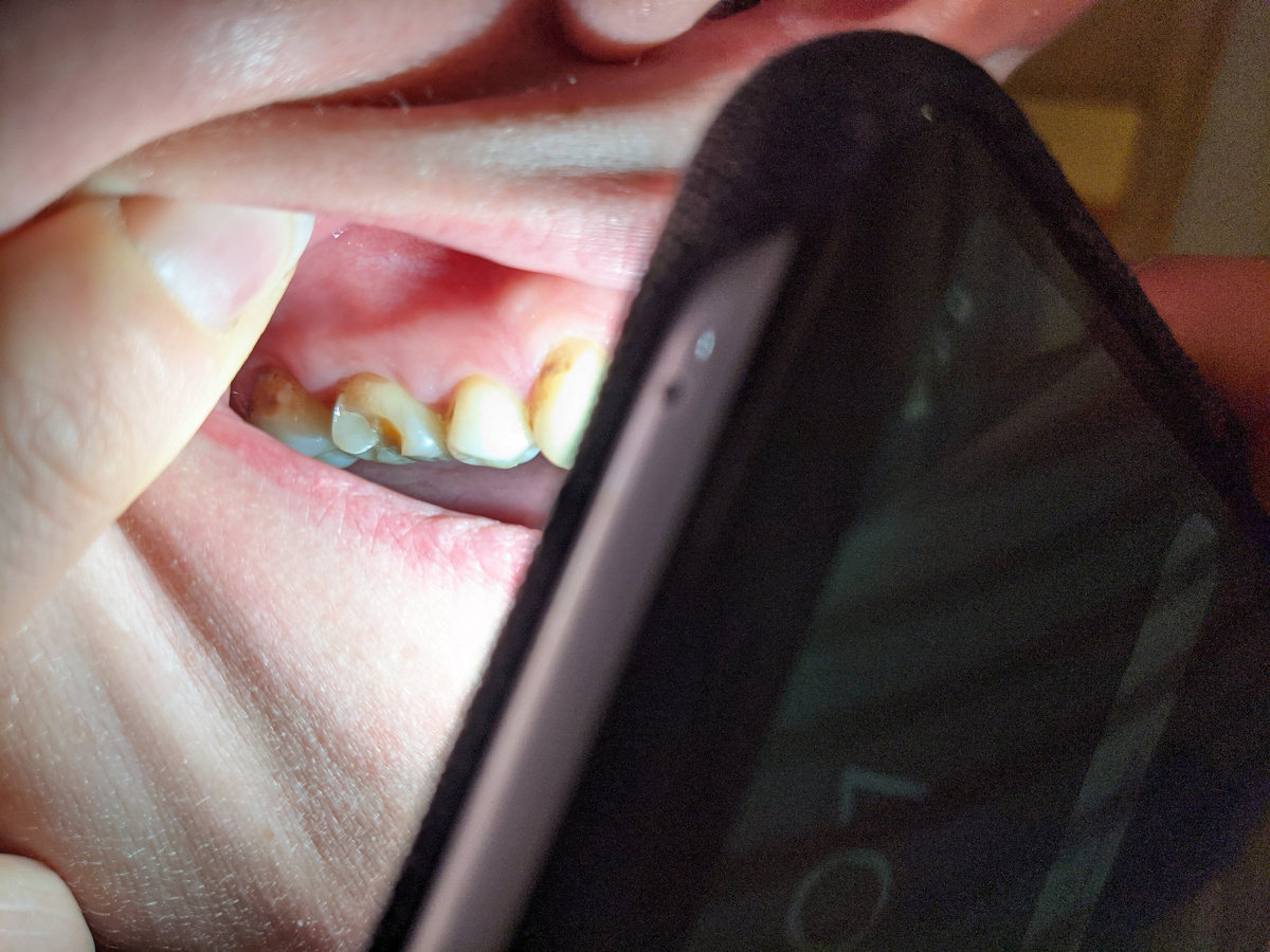 Освещаю зуб фонариком смартфона, а Вова делает фото