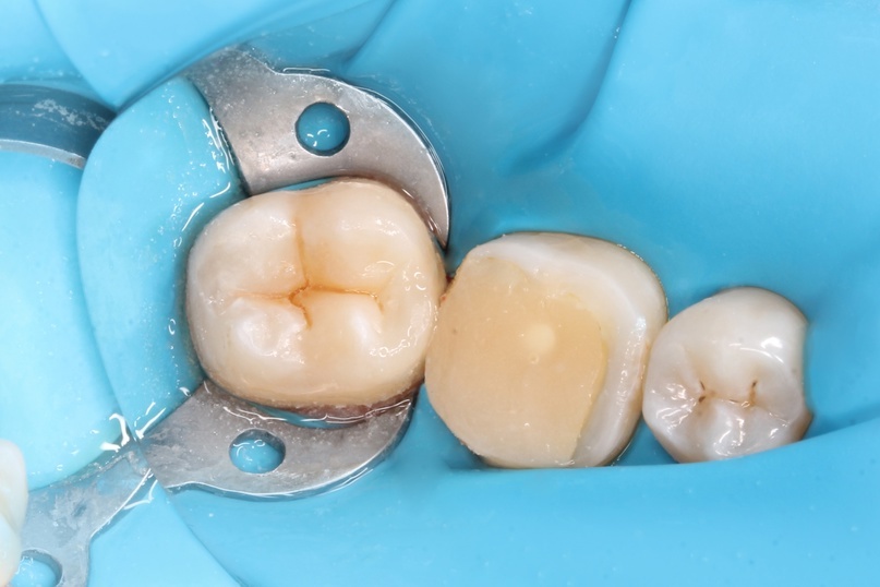 Лечение кариеса в клинике Наудент. Стоматолог-терапевт Новикова А.А.1 из 3