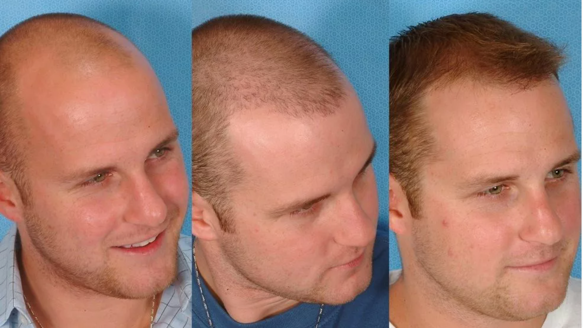 Этапы роста и восстановления волос после пересадки через 1, 2, 3 месяца