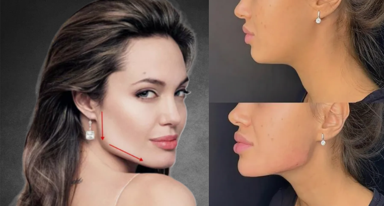 Углы Джоли и фото клиентки косметолога до и после коррекции филлером