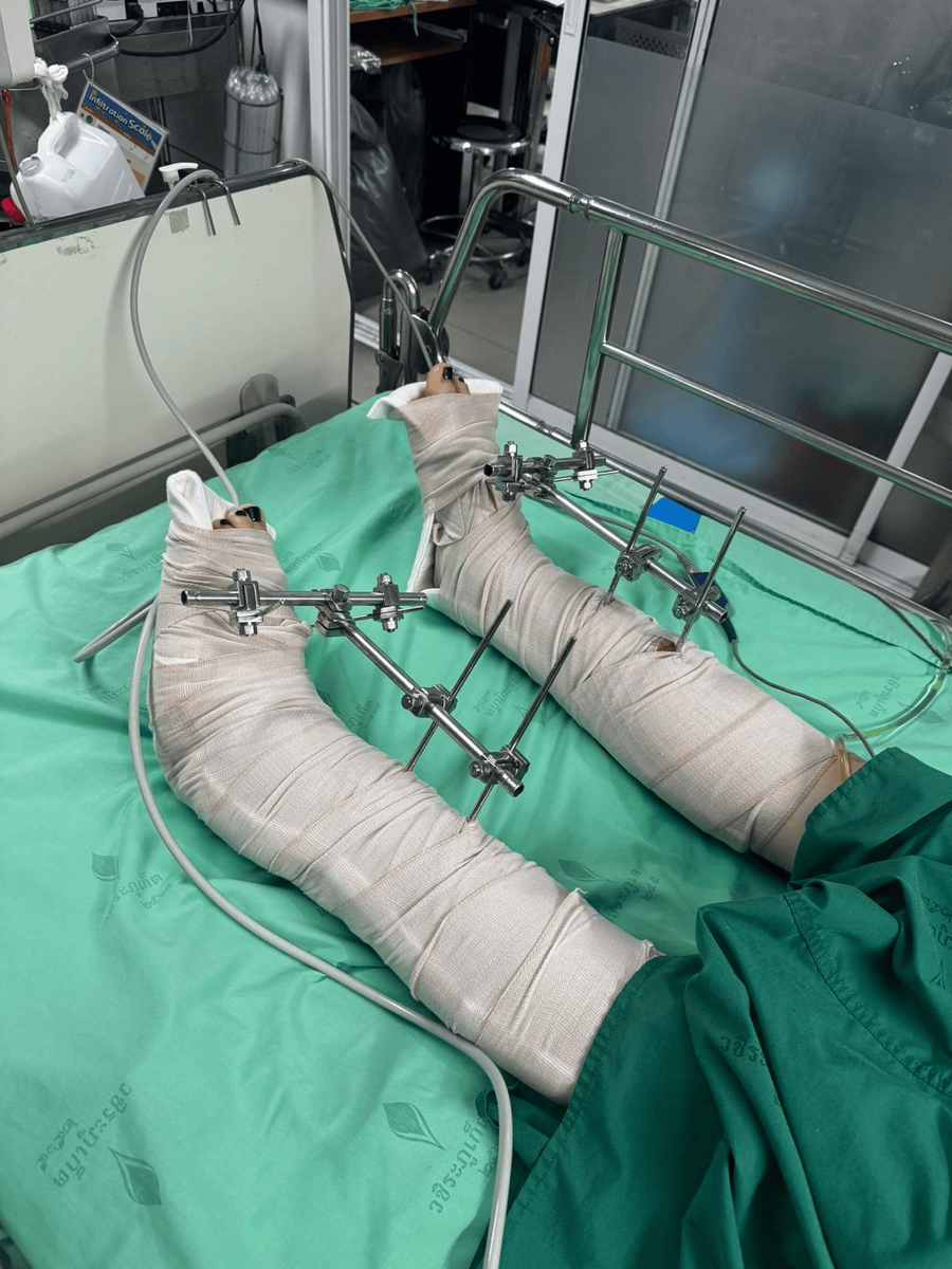 Каждая трещина, перелом - болит...  Долго Кате  еще жить  на обезболивающих препаратах. 