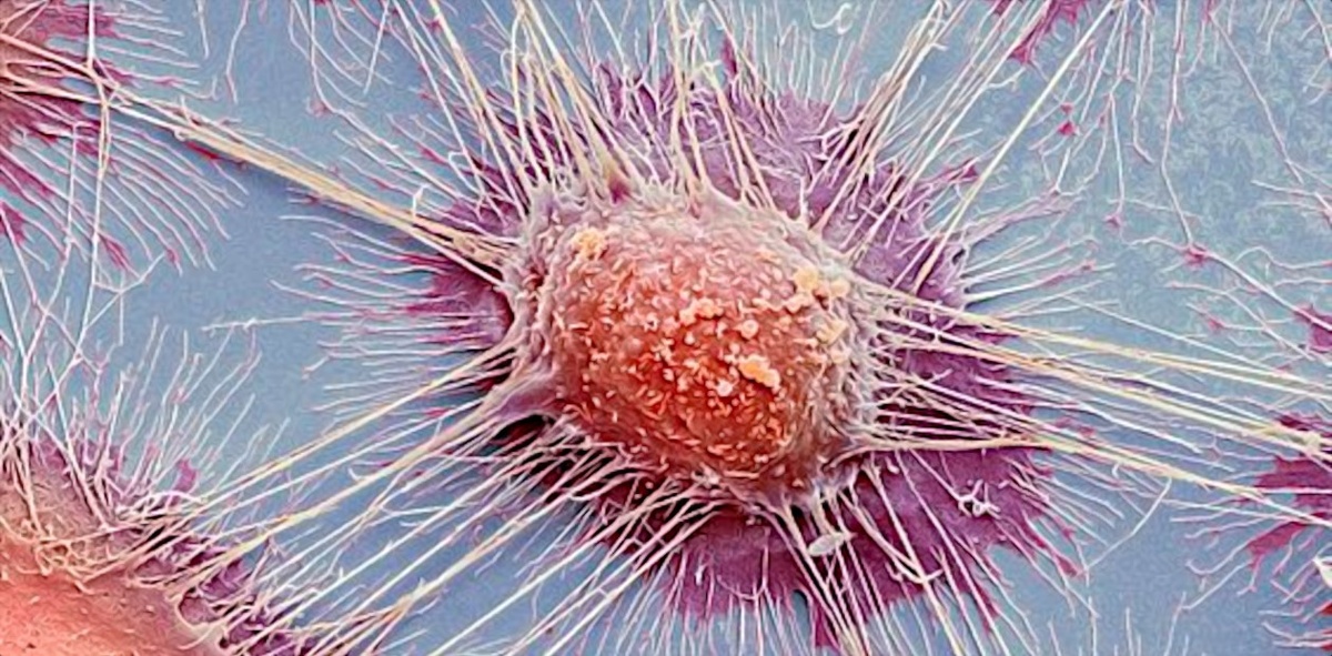 Клетки плоскоклеточной карциномы человека – раковой опухоли, обычно чувствительной к иммунотерапии