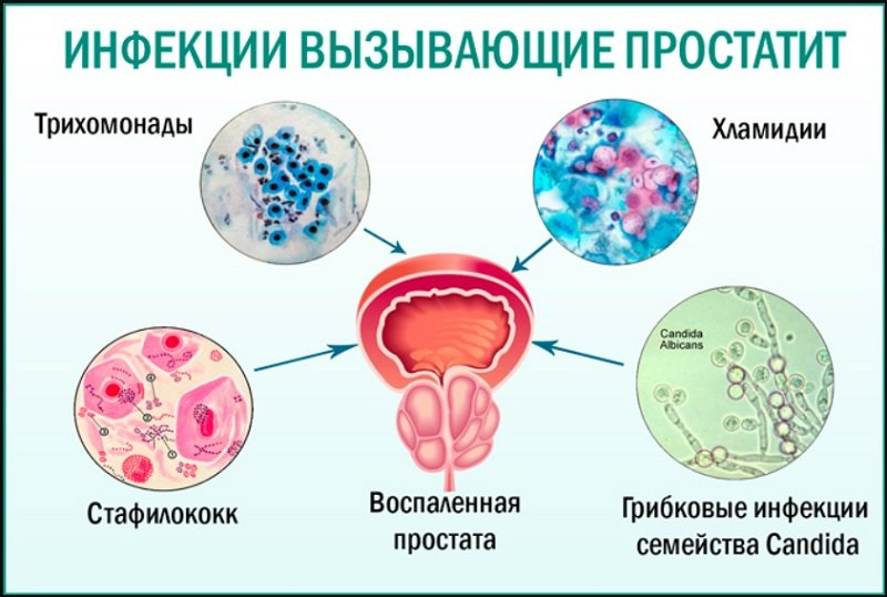 Простатит что нельзя есть и пить. Простатит что нельзя есть и пить