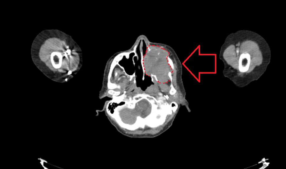 Стрелка указывает на опухоль, обведенную крастным пунктиром. На снимке хорошо видно, насколько левая половина лица больше правой