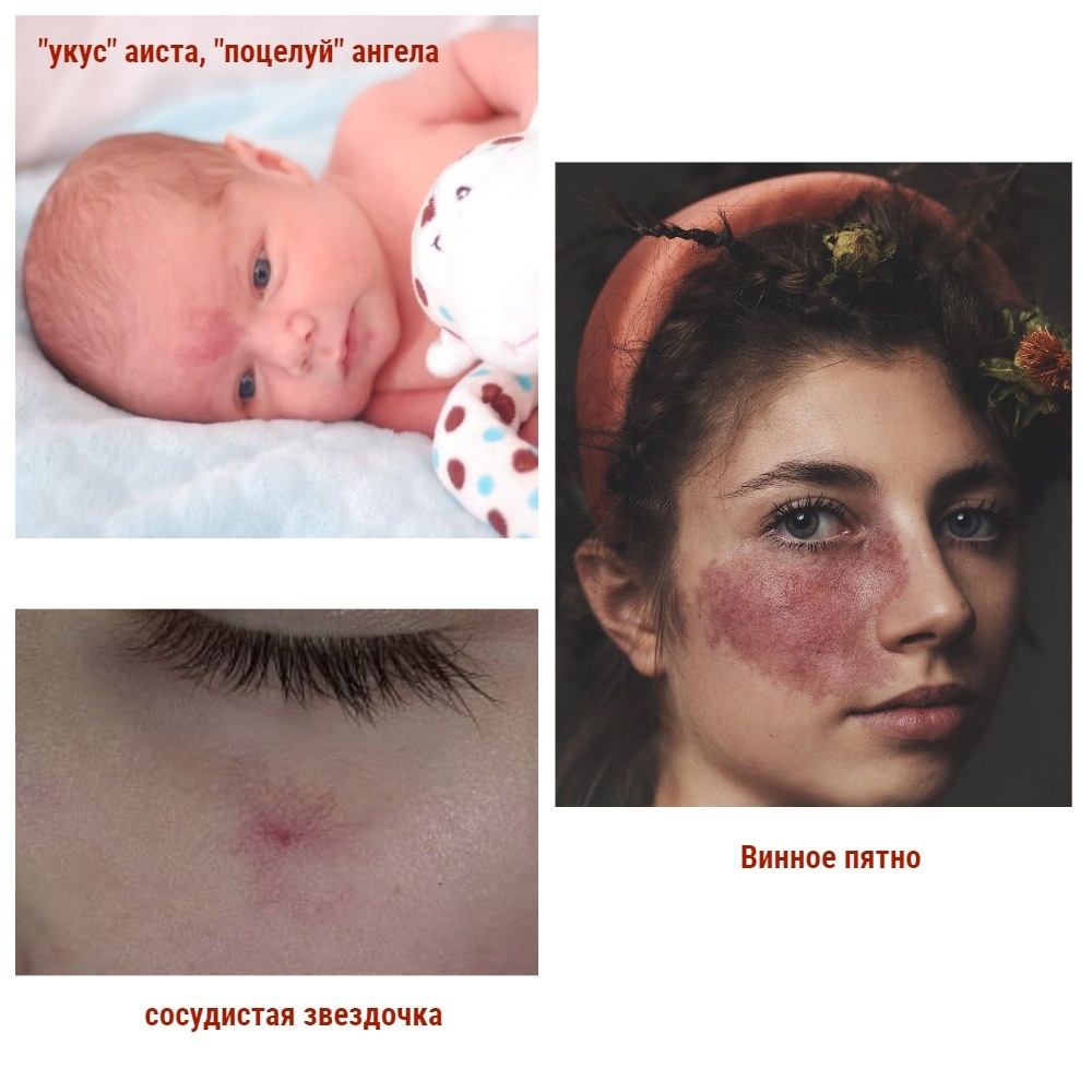 Наиболее частые проявления на коже капиллярной патологии