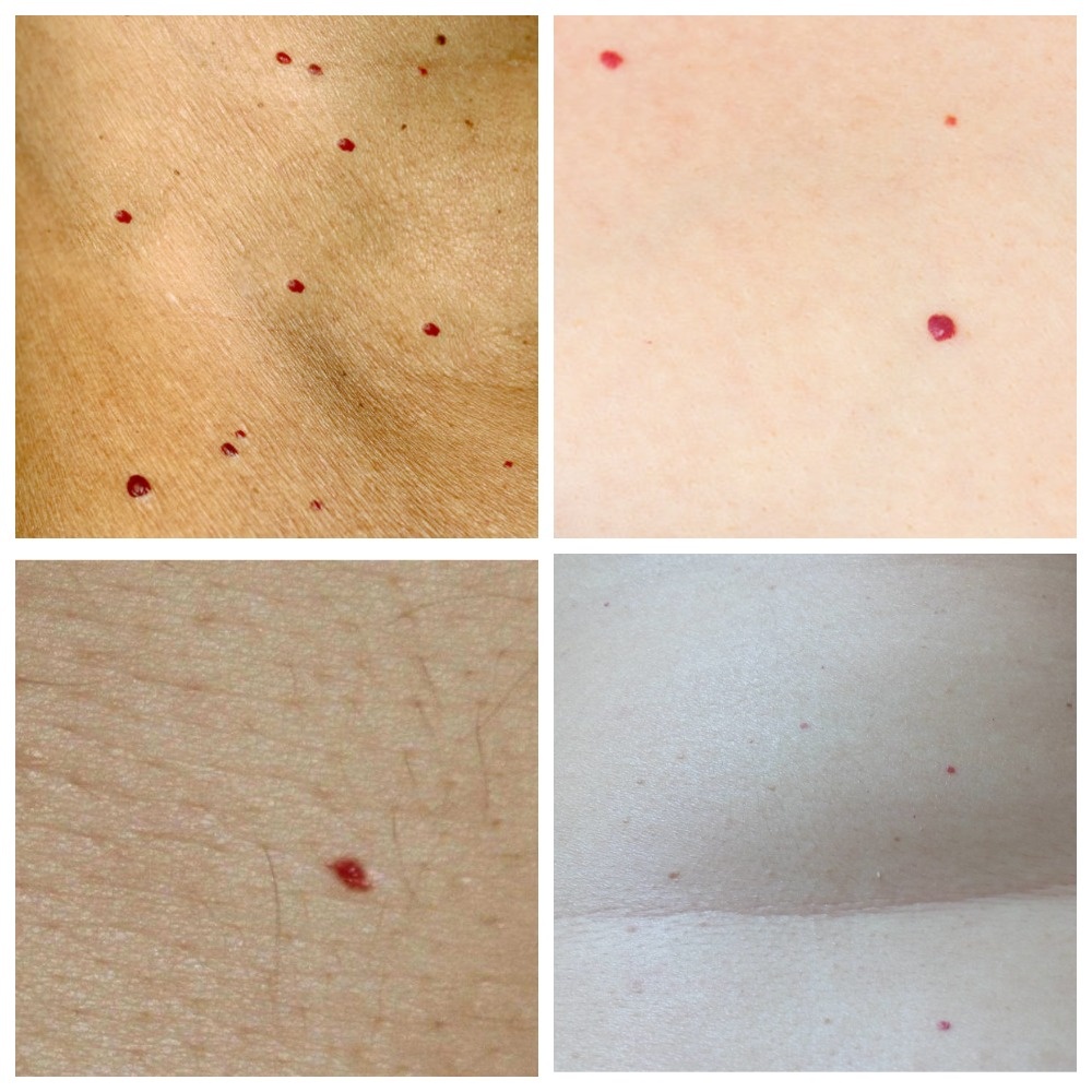  Примеры вишнёвых ангиом