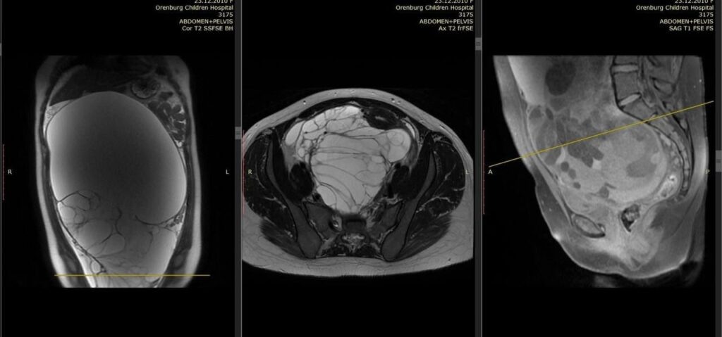    Оренбургские хирурги удалили у девочки-подростка восьмикилограммовую опухоль (18+) Оренбуржье