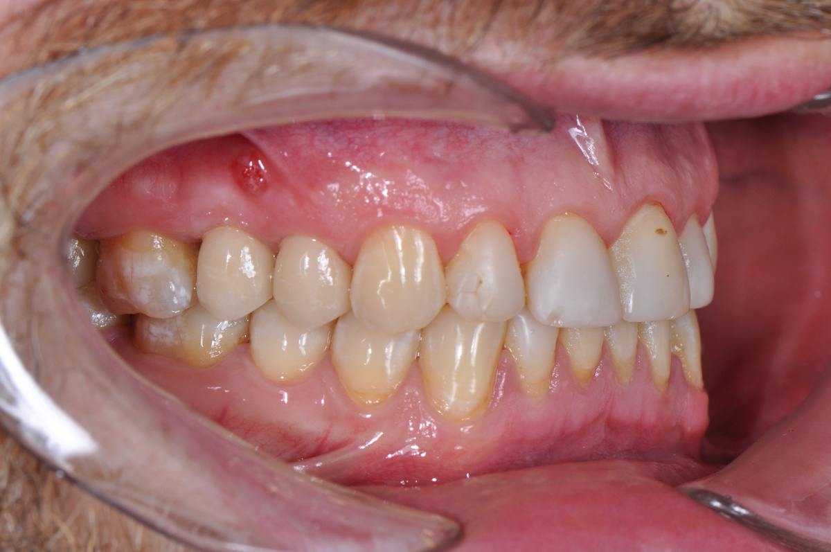 Пациент обратился с жалобами на свищ
