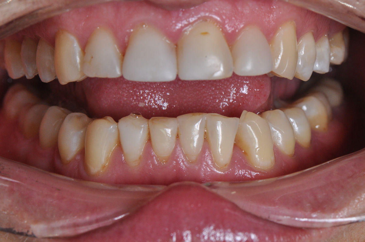 Неправильный прикус осложняет ситуацию