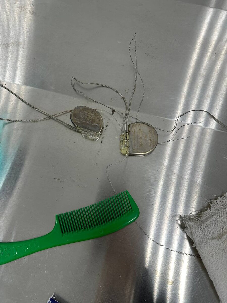 Извлеченный кардиостимулятор