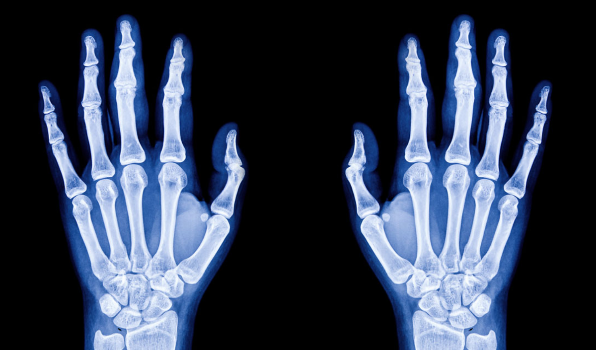 Аннета удивила родителей своей способностью. (Фото: www.hawaiipacifichealth.org).