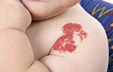 Гемангиома - это доброкачественная опухоль, которая возникает из-за аномального разрастания сосудов. У детей появляется довольно часто. Можно лечить примочками специального лекарства (не факт, что поможет), таблетками внутрь с ежемесячным контролем ЭКГ или лазером/электрокоагуляцией…При гемангиоме особо опасно кровотечение из нее, потому что его очень сложно остановить.