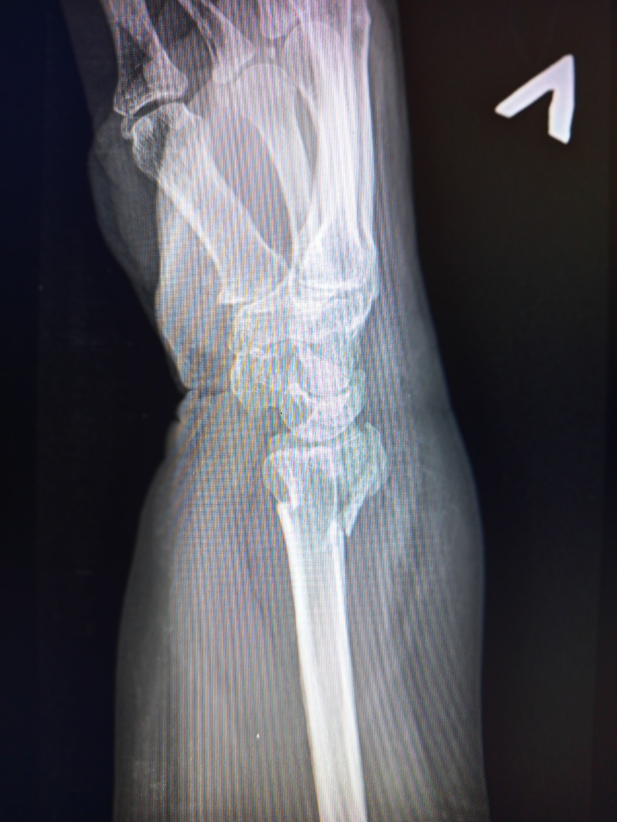 И шиловидный еще до кучи