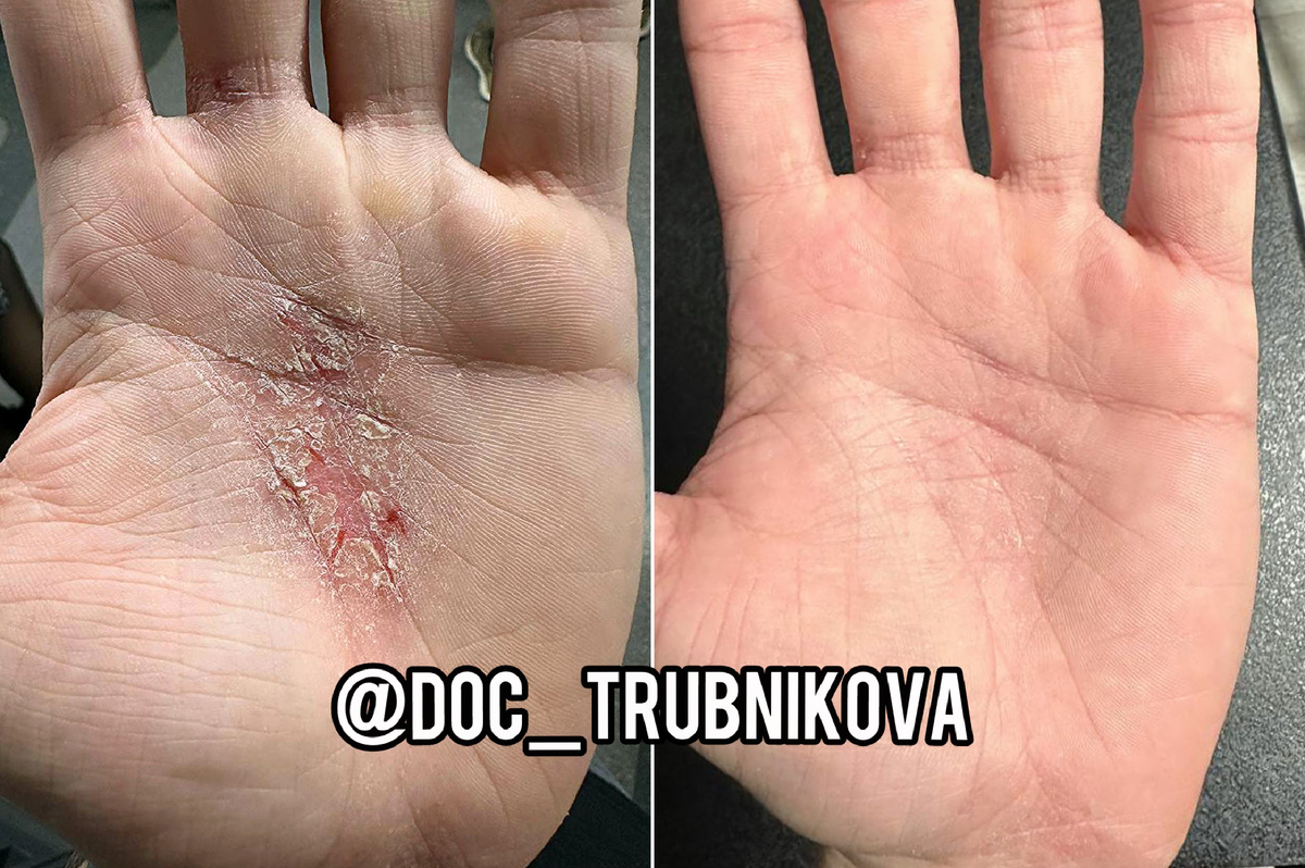 Мытье рук и умывание лица вызывали боль - вода попадала на открытую плоть ладоней 🥲