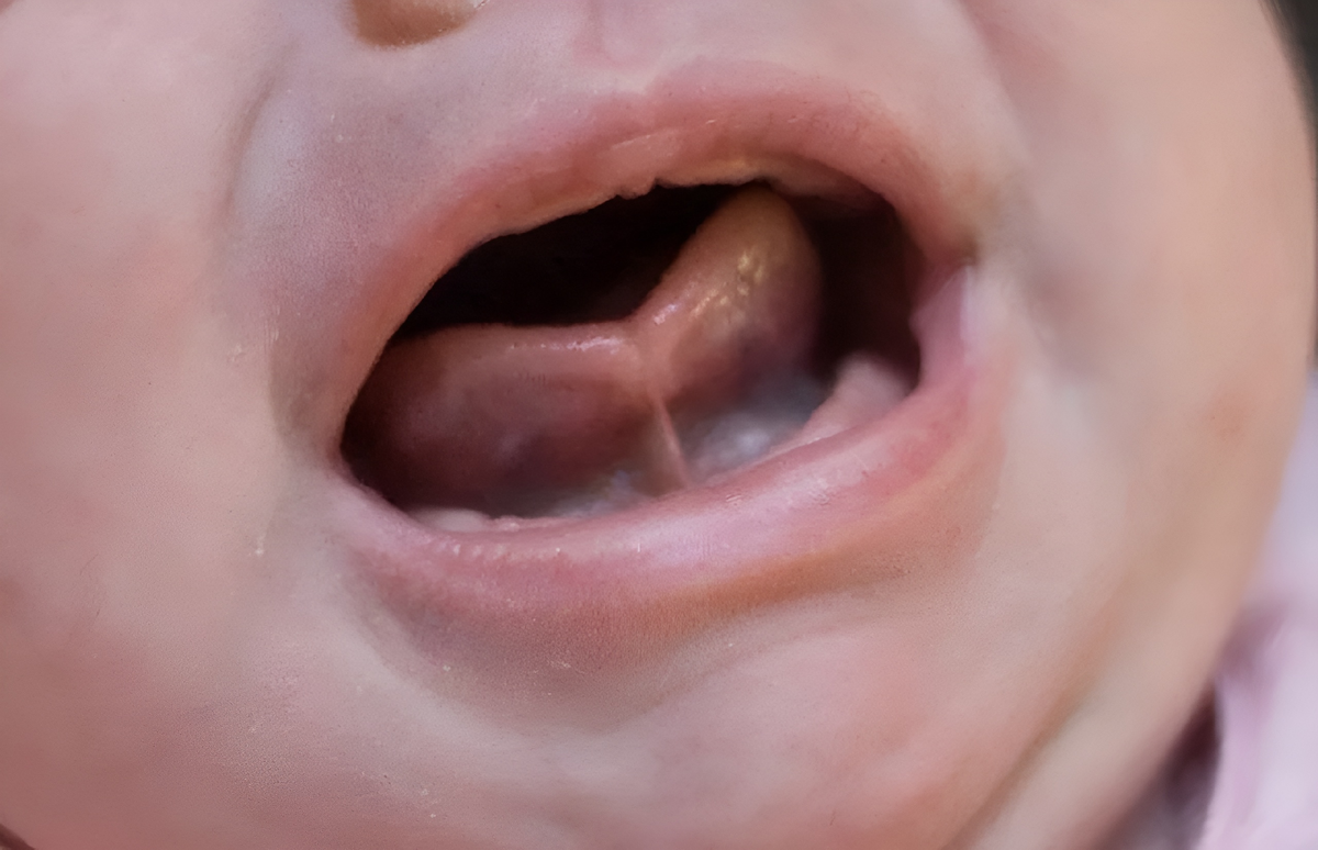 Короткая подъязычная уздечка